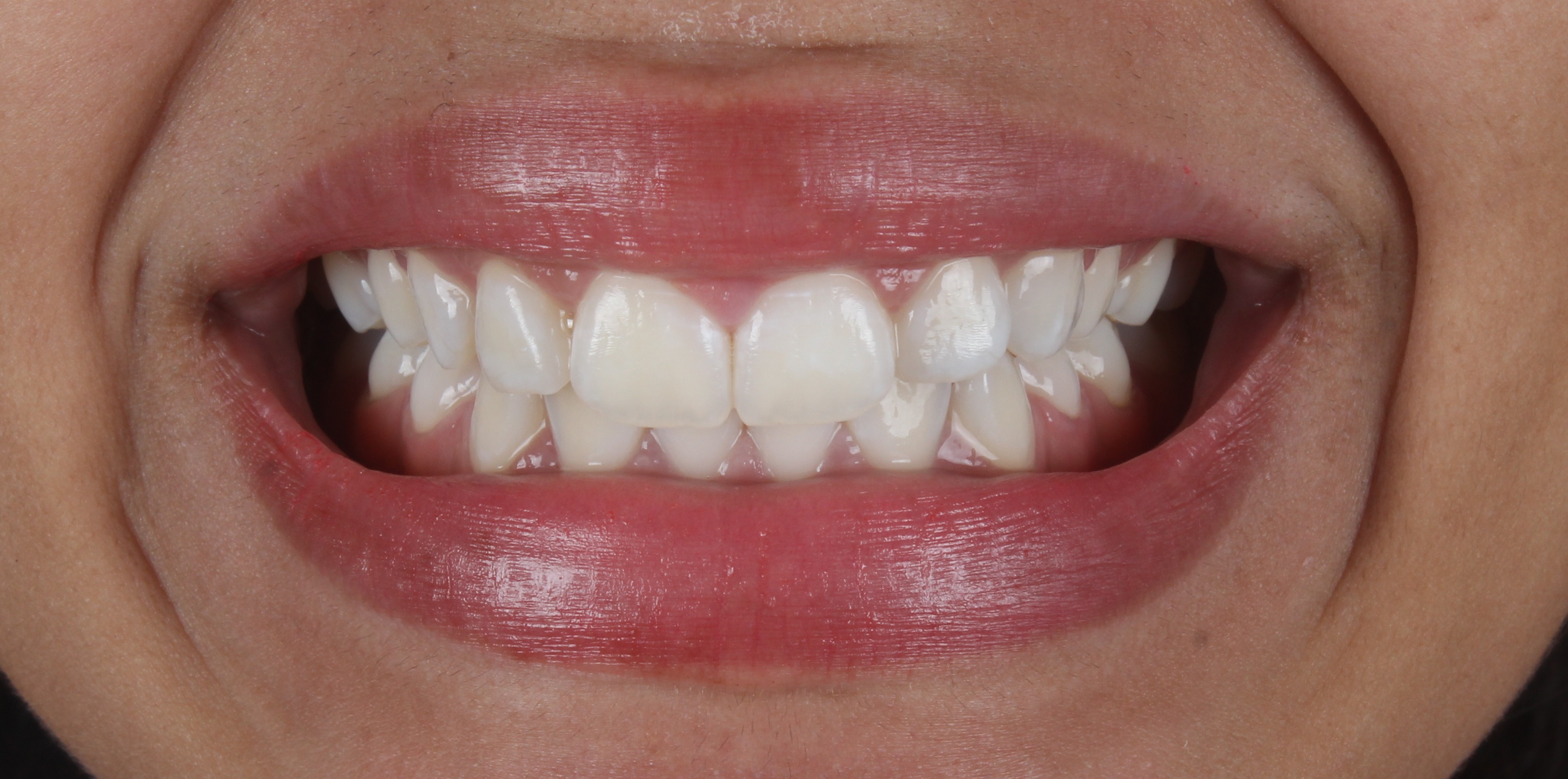 Depois do clareamento dental